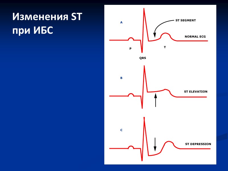 Изменения ST при ИБС